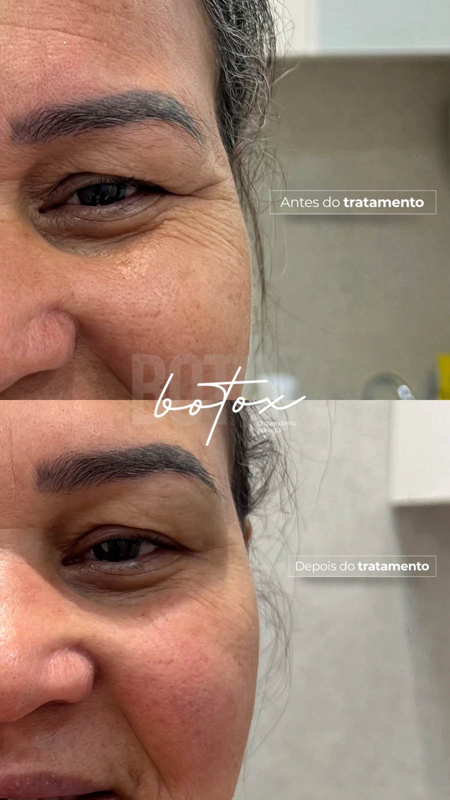 Antes e depois de aplicação de botox na TriSeé
