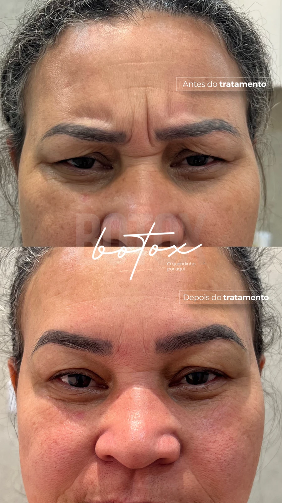Antes e depois de aplicação de botox na TriSeé