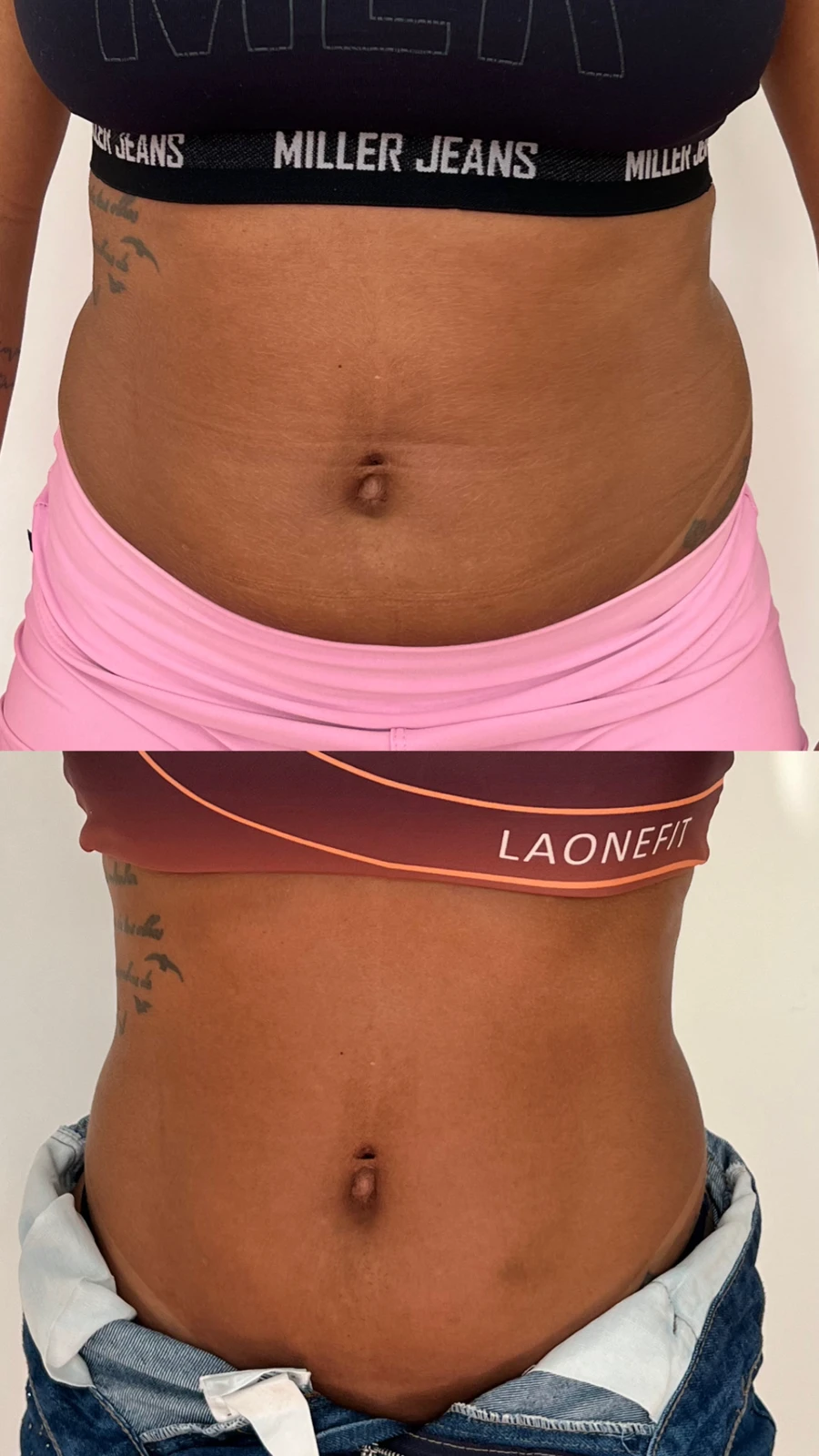 Antes e depois de protocolo corporal na TriSeé