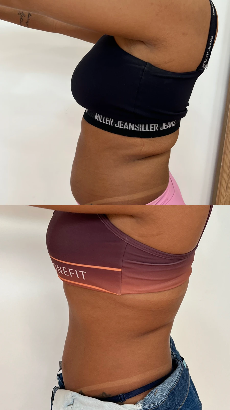 Antes e depois de protocolo corporal na TriSeé