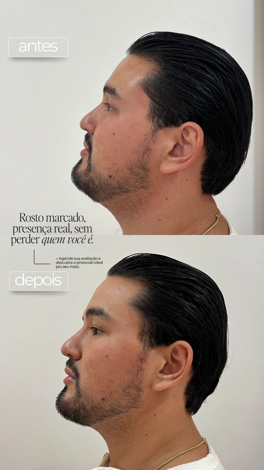 Antes e depois de harmonização facial masculina na TriSeé