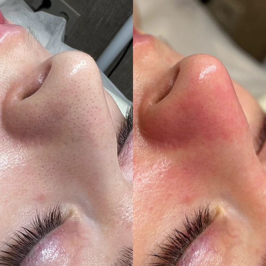 Antes e depois de limpeza de pele na TriSeé