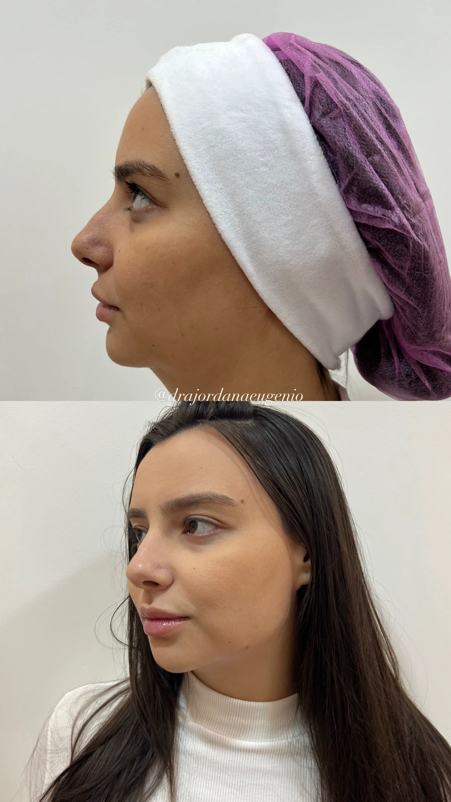 Antes e depois de perfiloplastia na TriSeé