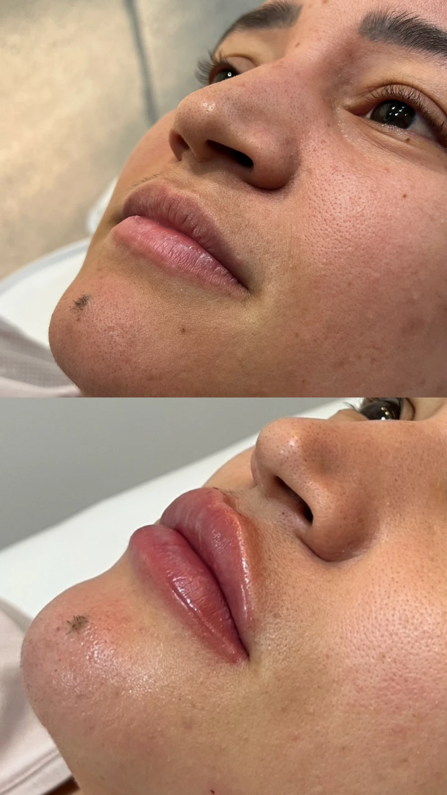 Antes e depois de preenchimento labial na TriSeé